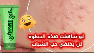 قبل أي كريم أو دواء......هذه أول خطوة للعلاج حب الشباب 