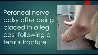 #5 Peroneal nerve palsy after being placed in a leg cast following a femur fracture
