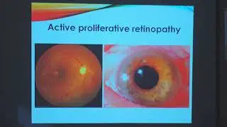 Indications of vitrectomy in diabetic retinopathy by dr Tarek Abdou
