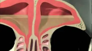 Ballon Sinuplasty by the doctors of ENT New Orleans