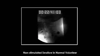 #e06 Preview:  Electrical Stimulation In The Normal And Impaired Swallow