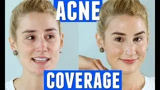 MINIMAL MAKEUP FOR ACNE COVERAGE | Depression Survival GRWM | HEYKACKIE
