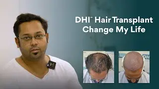Hair Loss Struggles to Full Transformation: DHI&trade;️ Changed the Game in 6 Months