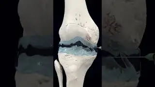 Knee osteoarthritis treatment using viscoelastic material#viral #viralvideo #drfelixmawuko
