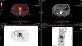 FAPI PET/CT scan in pancreatic cancer