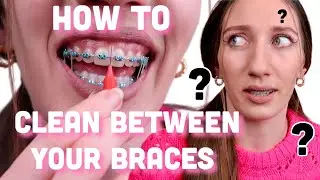 How to clean your braces after eating - remove food from between your braces and clean your teeth