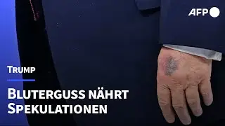 Bluterguss nährt neue Spekulationen über Trumps Gesundheit | AFP