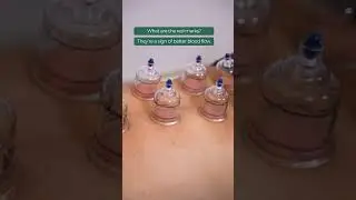 Chronic stiffness or lingering muscle pain? Try Manual Therapy & Cupping with Sujin | Kinesis Clinic