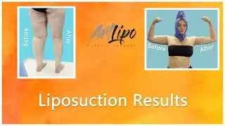Lipo 360&deg; | Liposuction Results | High-Definition | Expert Dr. Thomas Su