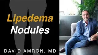 Lipedema Nodules  | United States | David Amron, MD