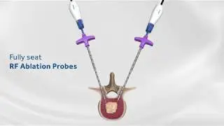 Spinal Tumor Radiofrequency Ablation at WVU Medicine