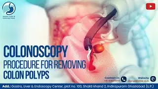 Colonoscopy Procedure for Removing Colon Polyps | Dr. Manish Gupta | Indirapuram, Ghaziabad (UP)