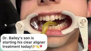 Dr. Bailey’s son gets aligners!  Invisalign Attachments 