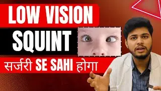Squint/Strabismus Home remedies and Eye exercise | Squint Cause of Low vision | Dr. Deepak Thakur