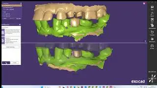 EXOCAD bite alignment scan