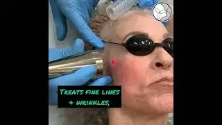 MicroLaser Peel