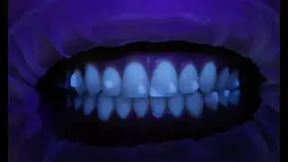 Mastering Attachment Placement For The Dental Assistant