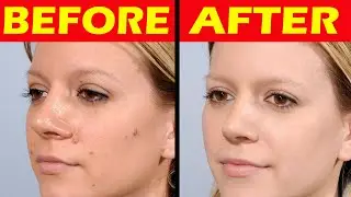 Remove Skin Tags Naturally | Nature Cure Fit