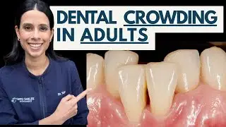 Dentist Explains How To Fix Crowded Teeth! What Is Dental Crowding in Adults