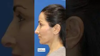 7-Month Facelift Update! Dr. Karam's WIFE'S Facelift Transformation!
