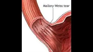 Mallory Weiss tear As a Cause of Upper Gastrointestinal Bleeding