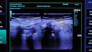 Sigmoid Diverticulitis Ultrasound