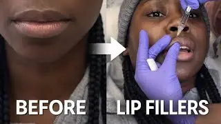 Lip Filler Journey as a Black Woman | Before & After + Healing