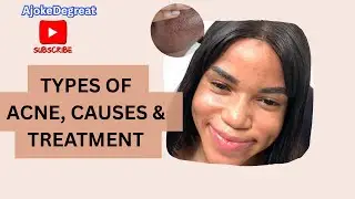 Skin Series Episode 4: Common Acne Types, Causes & Treatments 