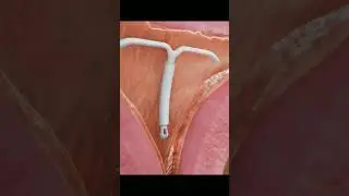 How Do IUDs (Intrauterine Devices) Work? | Birth Control #4k #animation #asmr