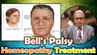 Bell's Palsy - Homeopathy Treatment - Dr. P.S. Tiwari