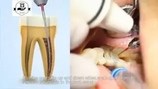 LED Ultrasonic Scaler Woodpecker UDS-E