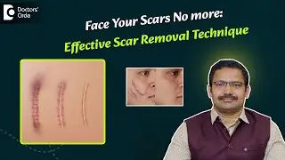 Accidental Scar Treatment on Face | Surgical Scar  - Dr  Deepak P Devakar | Doctors' Circle