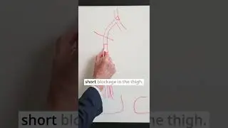 How Vascular Surgeons Choose Between a Stent or Bypass for Leg Pain #shorts