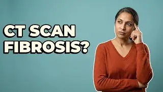 Do CT Scans Reveal Liver Fibrosis Signs?