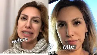 Braces FastBraces GRWM Look Hot with Braces