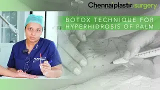 BOTOX TECHNIQUE FOR HYPERHIDROSIS OF PALM