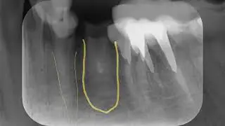 periapical de pr&eacute;-molares inferiores