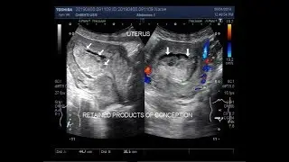 Ultrasound Video showing retained Products of conception inside the uterine cavity.
