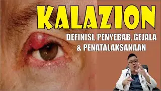 APA ITU KALAZION ?................. APAKAH KELAINAN INI BISA DISEMBUHKAN ?.............