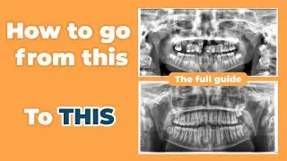 A FREE Orthodontic Guide - Class I & Impacted 11 - by @csorthoschool
