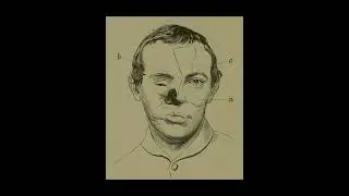 One Civil War Soldier's Worst Wound Was Not a Bullet #civilwarmedicine #civilwarhistory