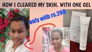 HONEST REVIEW OF SEBOGEL|| permanent solution for pimples whiteheads and blackheads|live clips added