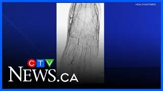Frostbite safety and ways to treat it