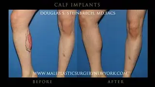Calf Implants for Men | Weekly Live with Dr. Steinbrech