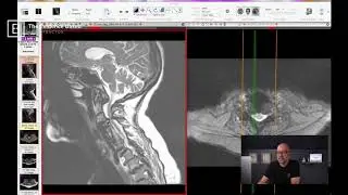 LIVE MRI Review of a Complex Cervical Fusion: Key Evaluation Points