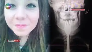Dişini karıştırdığı çatalı yuttu