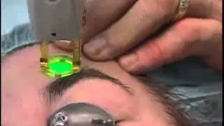 Gentle  YAG Laser Treatment