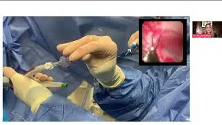 Ureteroscopy using the Richard Wolf single-use hybrid scope presented by Dr. Amy Krambeck