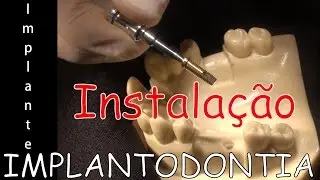 Instalação de Implante HE 3,75X13mm DSP - UFPE