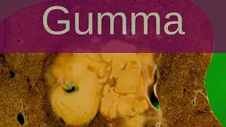 What is a Gumma? - Pathology mini tutorials